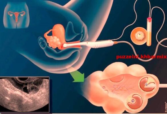 Hoe heet de techniek waarbij bevruchting in een reageerbuis plaatsvindt (3)